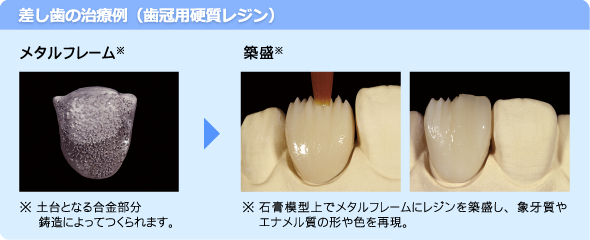 差し歯の治療例(差し歯の作製)