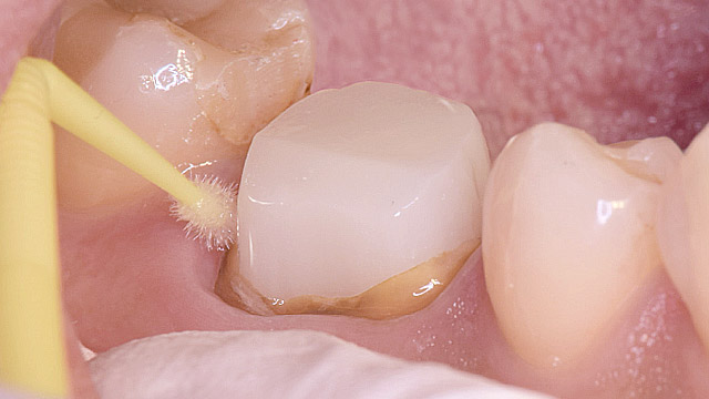 マリモセメント歯面処理